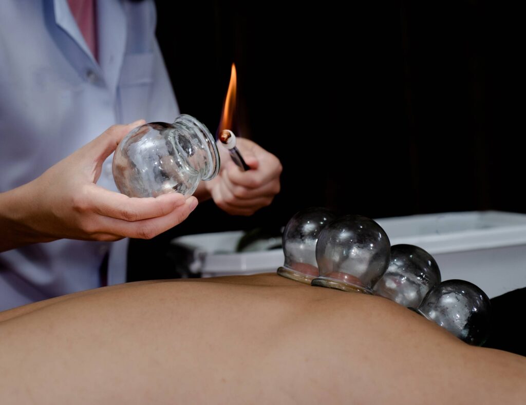 Cupping Therapy. Fire Cupping Removal of Glass Globe